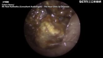16年沒清耳朵！醫挖出多坨巨黑耳屎