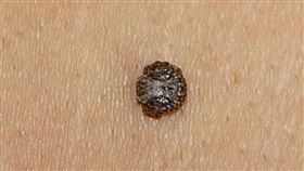 蜱蟲（國泰綜合醫院提供）