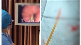 遼寧,牙籤,誤吞,手術,十二指腸（圖／翻攝自梨視頻）