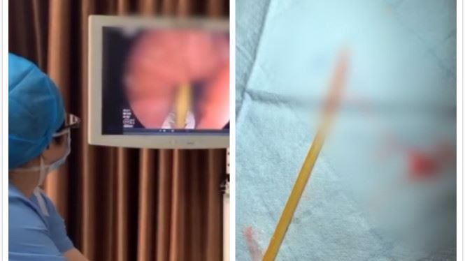 他誤吞牙籤卻沒事？醫：胃差點被刺穿