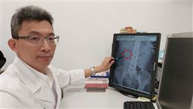 逆行性腎臟體內碎石術。（圖／恩主公醫院提供）