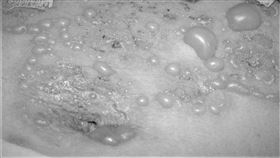 罕見皮膚病「類天皰瘡」 林口長庚與土城醫院找出問題藥物!(圖/林口長庚提供)