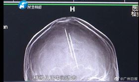 中國,河南,車禍,腦袋,X光,針（圖／翻攝自微博）