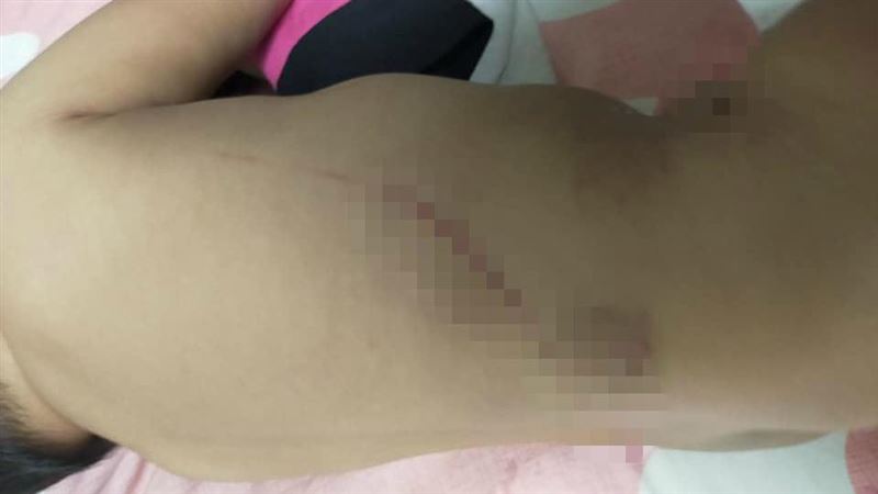 台中幼兒園虐童？母淚：1歲兒滿身傷