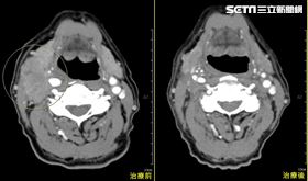 60歲老菸槍菸癮20年　頸部腫塊、吞嚥卡卡…下咽癌晚期（圖／亞大醫院提供）
