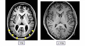 平腦症（圖／長庚醫院提提供）