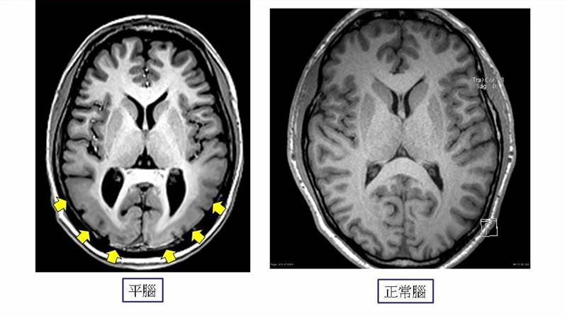 全球只有13病例　平腦症大腦無皺褶