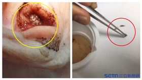 耳朵有蛆（榮民醫院台東分院提供）