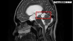 紅圈處為中腦腫瘤（圖／台大醫院新竹分院提供）