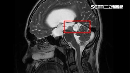 15歲男頭痛昏倒　竟是水腦併中腦腫