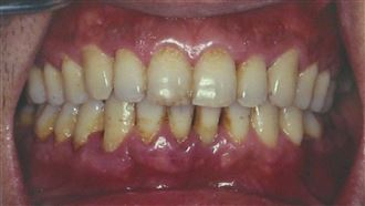 牙周病殺人於無形　醫警告這10件事