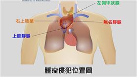50婦胸腺瘤拖8年、腫瘤養到8公分如壘球　14小時搶命（圖／台中慈院提供）