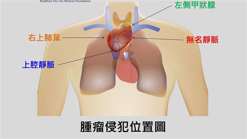 胸腺瘤拖8年　腫瘤養到8公分如壘球
