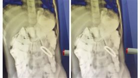 中國,福建,男童,誤吞,磁力珠,腸壁（圖／翻攝自梨視頻）