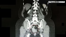 輕忽糞便潛血陽性　52歲婦長3公分腫瘤、大腸癌已上身（圖／大千綜合醫院提供）