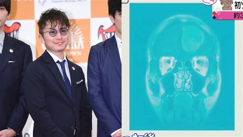 腫瘤比棒球大！男星開腦留3後遺症