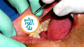 口腔的偽囊腫病兆 黏液囊腫(圖/臺北市立聯合醫院提供)