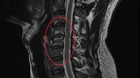 圖片：MRI檢查顯示病人頸椎退化，椎間盤略突出壓迫神經（紅圈處），故出現肩臂麻痛的症狀。(圖/臺北市立聯合醫院提供)