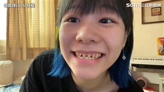 職業傷害！大胃王花高價做28顆假牙