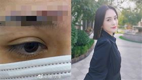 阿嬌首度秀出超驚悚傷痕狀況。（圖／翻攝自鍾欣潼微博）