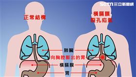 「橫膈膜裂孔疝氣」胃食道逆流半世紀　仁波切在台灣治好了（圖／台中慈院提供）