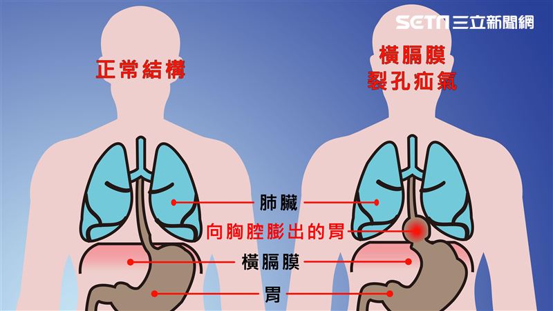胃食道逆流半世紀　仁波切在台灣治好