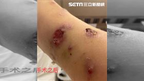 傷口　爛瘡疤（圖／翻攝自杭州交通918）
