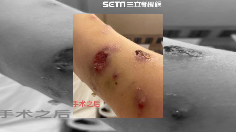 打蛋白液瘦身失敗　正妹剮皮挖肉保命
