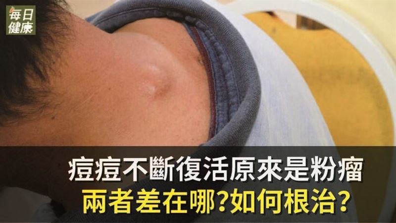 痘痘不斷復活　原來是「它」在搞鬼！