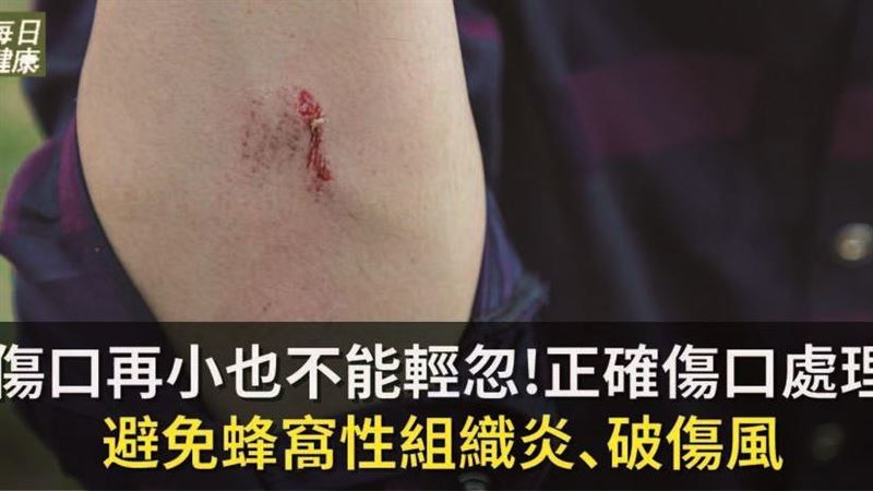 傷口再小也不能輕忽！醫師建議４步驟