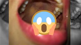 拔智齒,喉嚨,傷口