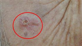 詭異紅斑不痛不癢但會「長大」7旬婦確診皮膚癌（台中醫院提供）