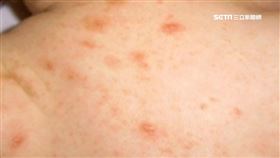 1人染疥瘡傳染17人! 中榮爆發群聚感染
