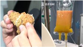 吃炸雞小心！孕媽嘴饞連嗑2天…竟送急診抽出滿滿「黃油」（圖／翻攝自看看新聞）