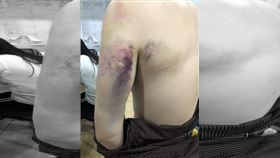 台灣男子在菲博弈求職遭綁　身上大片瘀青一名台灣籍男子在菲律賓向博弈公司求職後遭擄人勒贖，對方毆打凌虐這名男子，導致他左肩、左背、手臂大片瘀青。（駐菲代表處警政祕書王智勇提供）中央社記者陳妍君馬尼拉傳真　109年9月28日