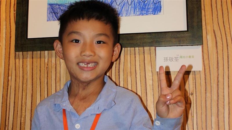 7歲童意外燒傷：希望大家和我一起玩