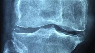 肌少症奪命於無形　醫曝這11人危險