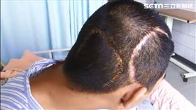 16歲高中生頭痛暈倒送醫瞳孔放大　竟是腦動靜脈畸形破裂（圖／大林慈濟醫院提供）