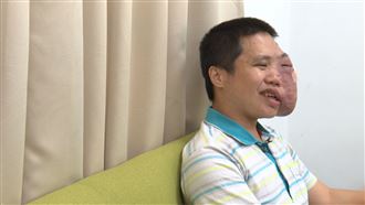 半邊臉嚴重變形　陽光男孩現況驚人
