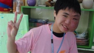 血管瘤臉部變形　卻最常聽長輩說這句