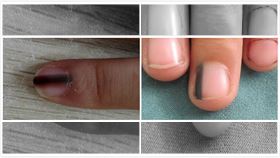 指甲有黑線=罹癌？皮膚醫5症狀解密(圖/翻攝畫面)