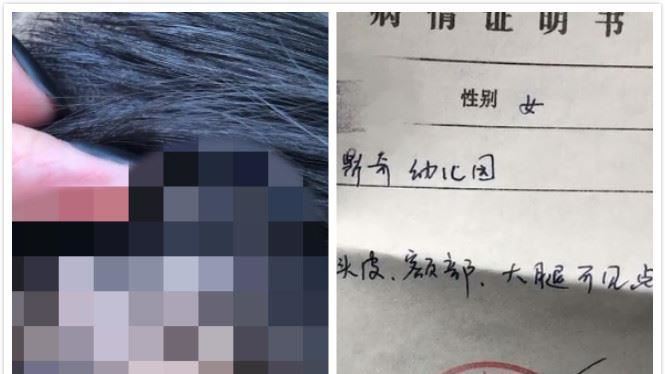 童下課身上見不明紅點！真相家長心碎