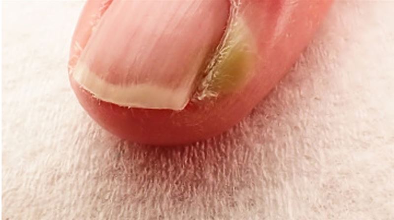 甲溝炎會腫、會痛　分急性與慢性兩種