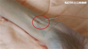 40歲女胃癌末期　化療前為什麼要先針灸？（圖／台中慈院提供）