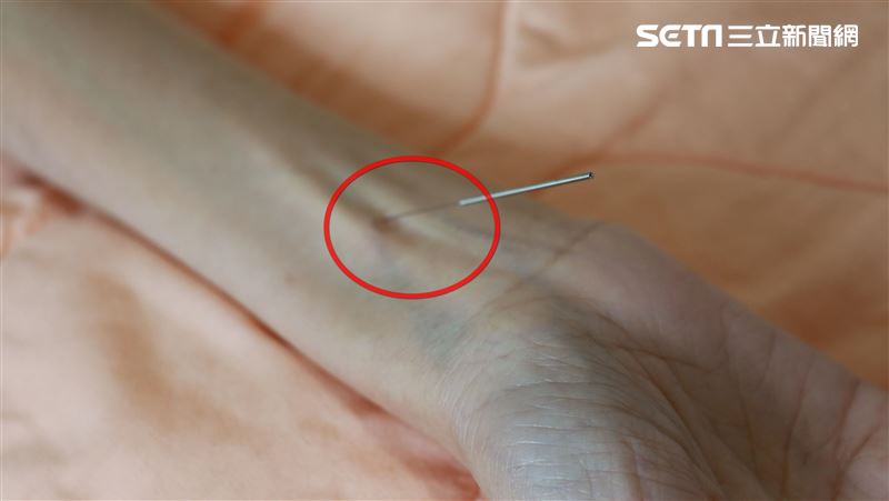 40歲女胃癌　化療前為何要先針灸？