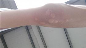 蚊子,叮,防蚊液,櫛瓜,癢