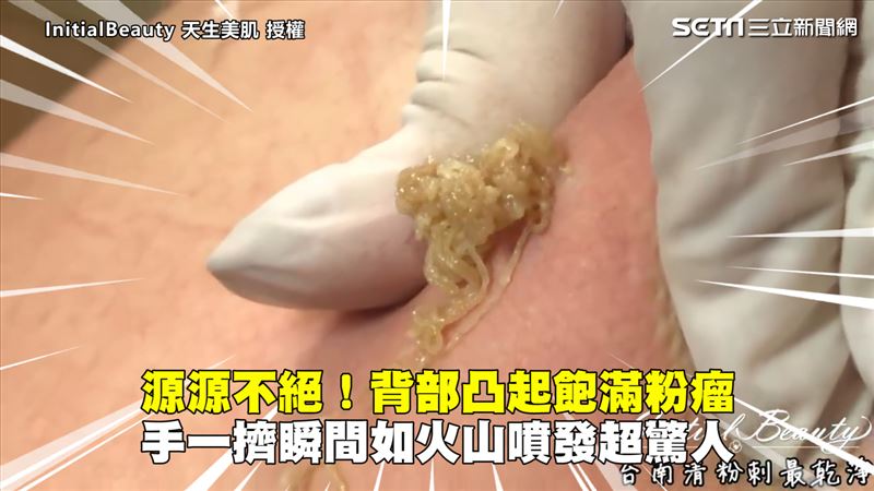 粉瘤飽滿凸起　一擠如火山噴發超驚人