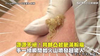 粉瘤飽滿凸起　一擠如火山噴發超驚人