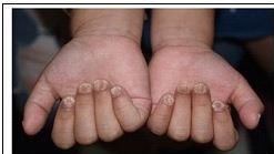 小恩就醫時的症狀。
