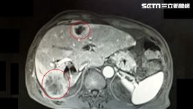 65歲男6公分大肝膿瘍治不好　原來是肝內管癌作怪！（圖／大千綜合醫院提供）